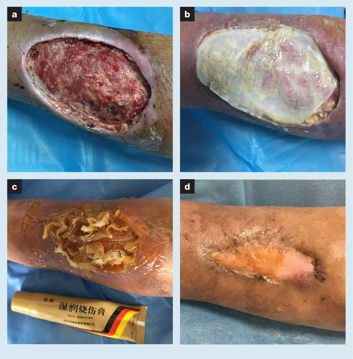 Silk Road - Combined application of moist exposed burn ointment and maggot  therapy in wound healing